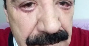 Göz doktoru tarafından estetik operasyon yapılan şarkıcı Hacı Kalan'ın yüzü tanınmaz hale geldi