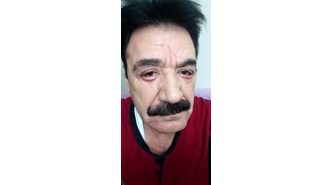 Göz doktoru tarafından estetik operasyon yapılan şarkıcı Hacı Kalan'ın yüzü tanınmaz hale geldi
